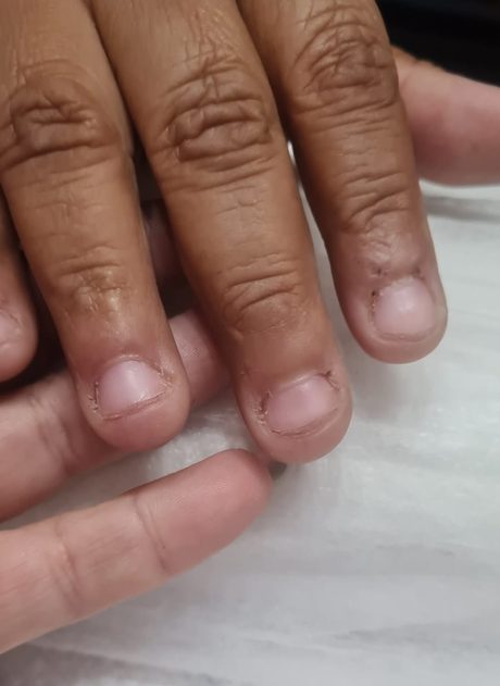 Unha fraca antes do atendimento