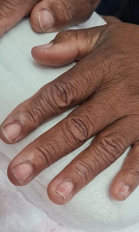 A mesma mão antes, com as unhas fracas e curtas