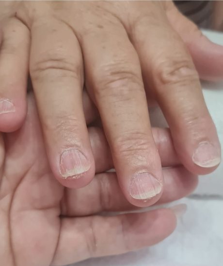 Unha fraca antes do atendimento