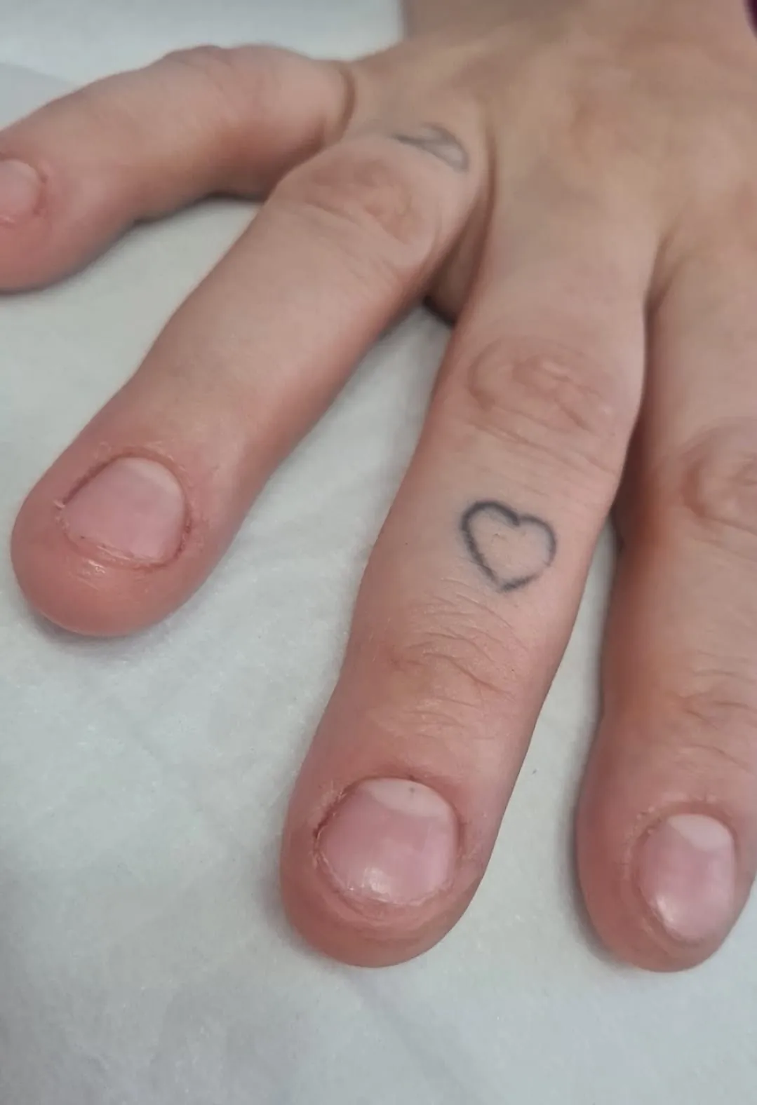 Unhas roídas bem curtas, antes do tratamento