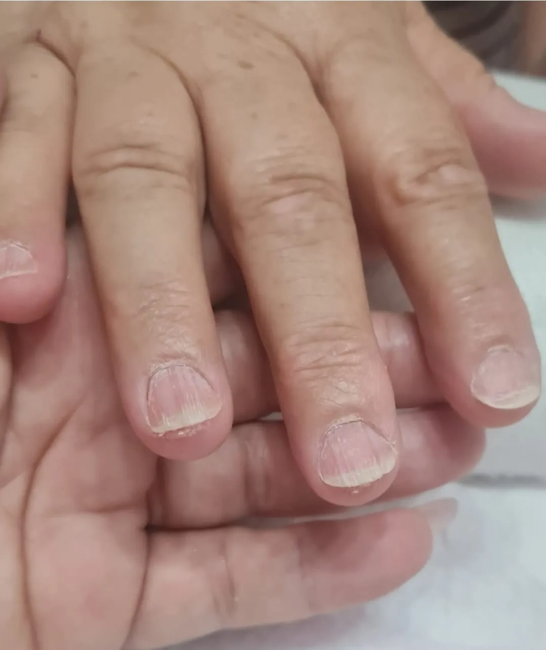 Unhas fracas, com estrias e pontas descamando